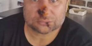 unlu-sarkicinin-yuzu-curumeye-basladi-entube-edildi-eI4IW8s4